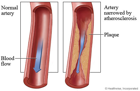 HVI Atherosclerosis